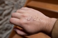 サル痘は性感染症ではないがキスなど濃厚な接触には注意を──CDCガイドライン