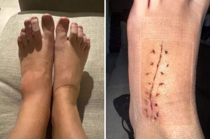 刺さった木のとげを放置して起きた悲劇