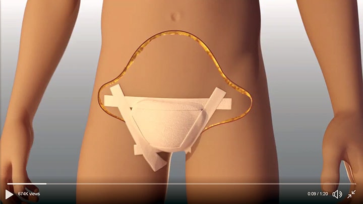 移植手術は大掛かり。ヘソの下まで大きく切開する　HopkinsMedNews/TWITTER