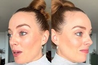 女性の顔にできた「ニキビ」が実は......医師が「皮膚がん」の疑いありと見抜いたポイントとは？