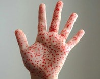 【クイズ】「麻疹（はしか）」の最も有効な予防法は？