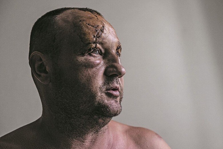 クレメンチュクのショッピングセンター爆撃で負傷した45歳の男性　METIN AKTASｰANADOLU AGENCY/GETTY IMAGES