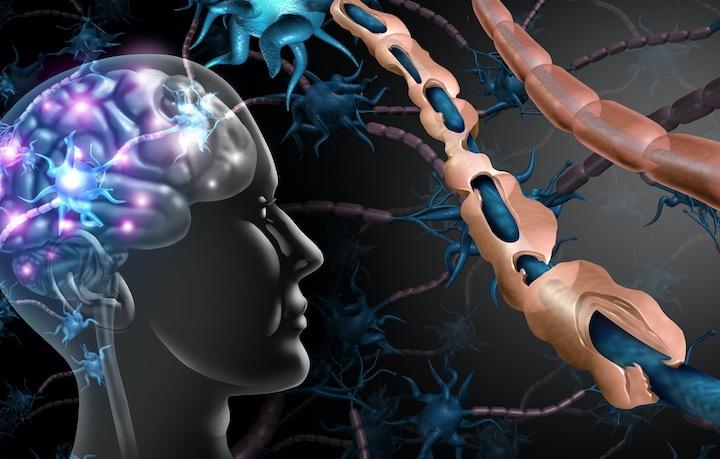 青年期の様々な感染症が多発性硬化症のリスクを高める  wildpixel -iStock