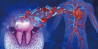 歯周病はなぜ危険なのか──心臓、脳、腎臓まで蝕む「慢性炎症」の連鎖