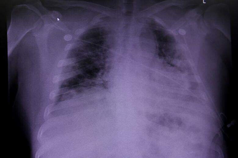 英国の科学者などが行った研究で、新型コロナウイルスに感染して死亡した患者の大半で肺に治りにくい広範な損傷が見られたことが分かった。写真は新型コロナウイルス感染者の肺のレントゲン写真。テキサス州ヒューストンの病院で７月撮影（２０２０年　ロイター/Callaghan O\'Hare）