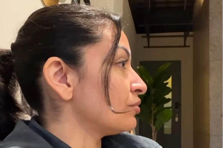 鼻の整形手術を受けた女性の後悔