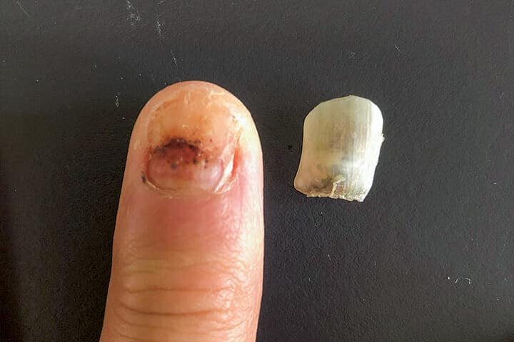 ワーホリ先の重労働で剥がれた爪