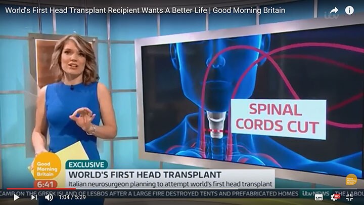 頭部移植の理論的な仕組みを解説するイギリスのテレビ局　itvNEWS/YOUTUBE