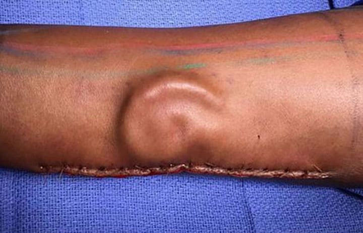 女性兵士の前腕で育てた耳。米軍外科医が移植手術に成功した U.S. Army