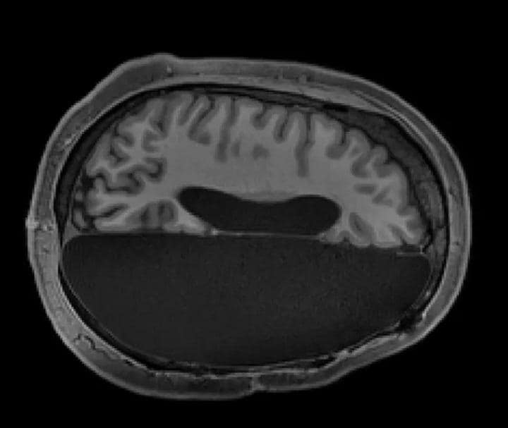 この半分しかない脳でも普通に話したり歩いたりできる　CALTECH BRAIN IMAGING CENTER