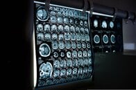 ADHDの人は「認知機能低下」のリスクが高い？　米20万人調査で判明