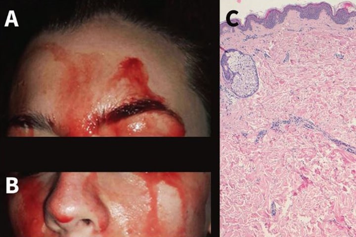 症例が報告された21歳の女性患者　Roberto Maglie/University of Florence/CMAJ