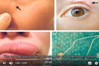 「顔に何かいる...」寄生虫は顔面にも住みつく　レジャーシーズンに気をつけたい予期せぬハプニング