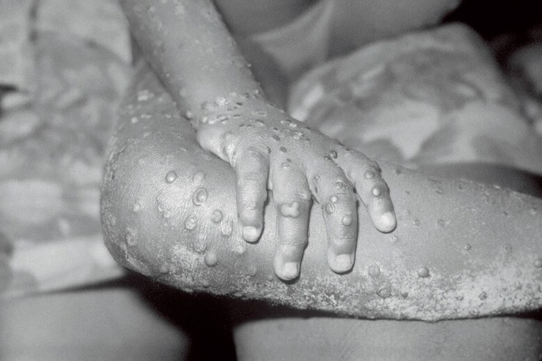 現時点で感染者の大半は同性・両性愛者の男性だ（写真は感染した4歳女児）　BSIPｰUIG/GETTY IMAGES