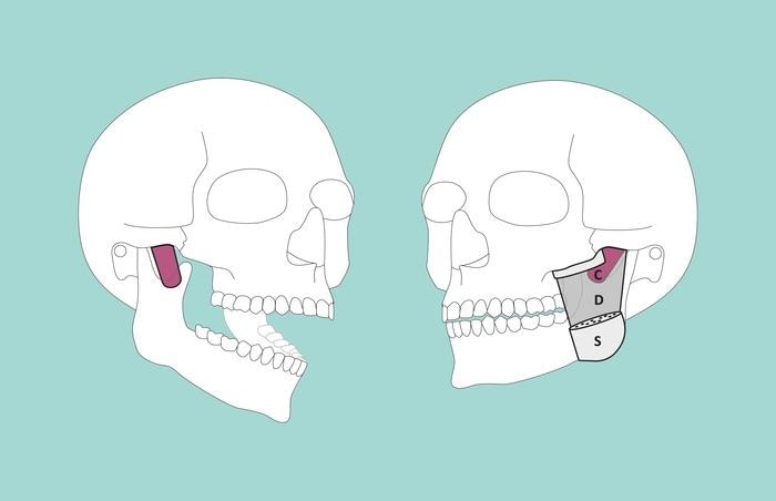 Low-Res_Illustration_Masseter_neu.jpg