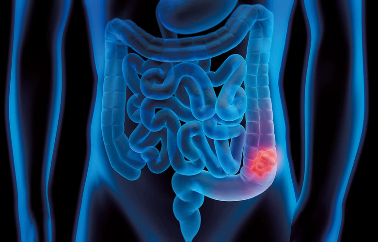 アメリカではこの30年で大腸癌が見つかる若者が倍増している　ILLUSTRATION BY PETERSCHREIBER.MEDIA/ISTOCK