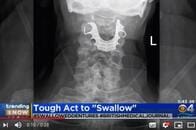 入れ歯を外さずに手術を受けた男性の辛すぎる術後