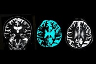 レカネマブのお世話になる前に──アルツハイマー病を防ぐため脳の老廃物を洗い流す科学的な方法とは