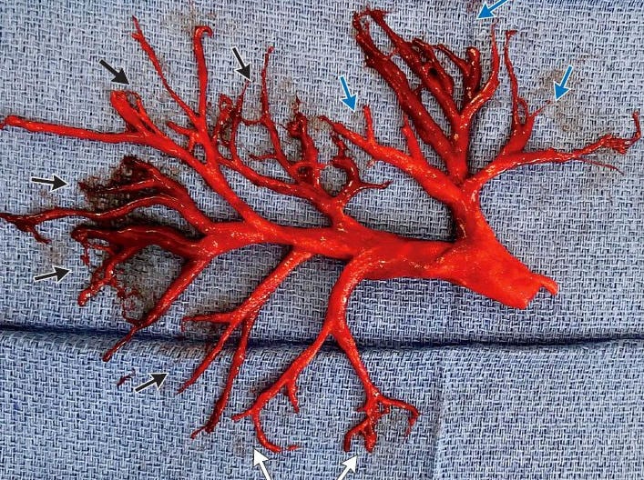 吐き出された気管支の形状に固まった血の塊 Woodward et al./NEJM-twitter