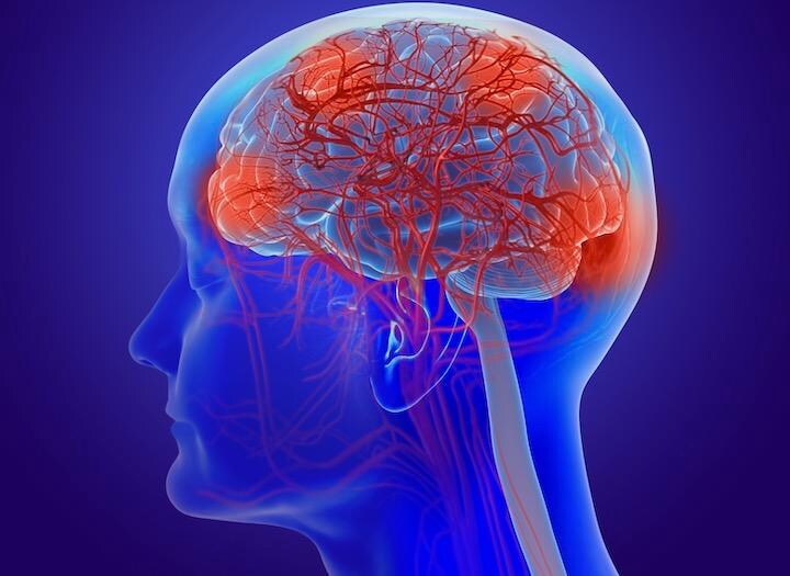 アルツハイマー病の予防やその進行を遅らせるための新たな治療の道をひらく成果  Lars Neumann-iStock