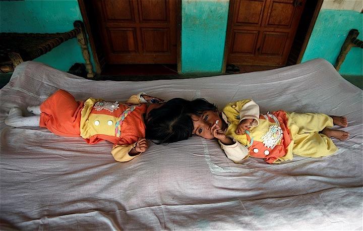 頭部でつながった結合双生児として生まれた2歳のサファちゃんとマルワちゃんは、頭蓋骨、脳そして血管を分離する手術を受けた。Fayaz Aziz - REUTERS