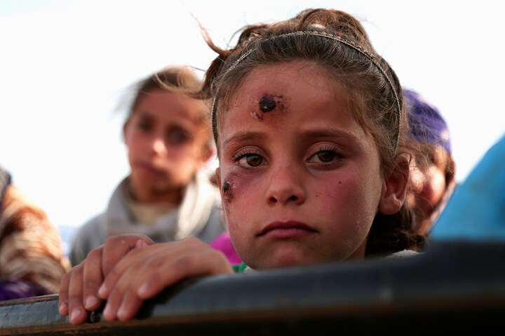 シリア政府軍がISISから奪還した町に戻ってきた少女の頬にリーシュマニア症の症状が見られる　Rodi Said-REUTERS