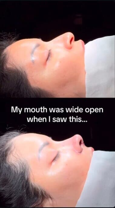 鼻の整形手術を受けた女性の後悔