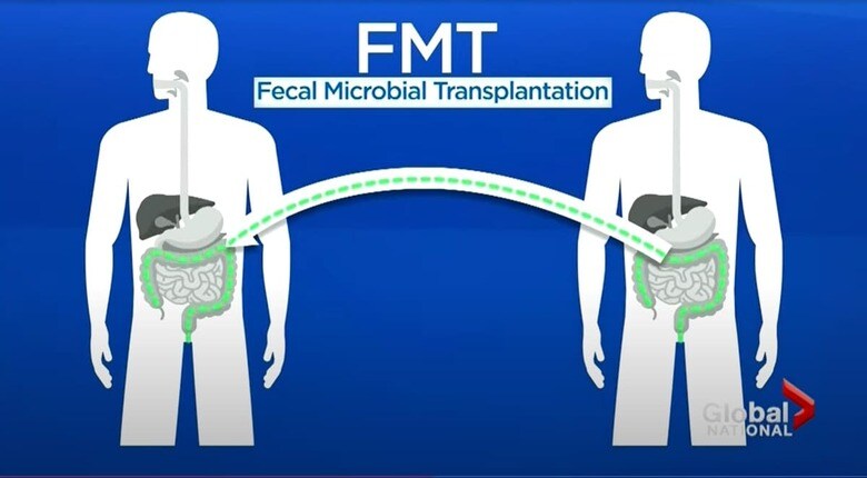 腸内環境を正す治療法として期待されつつ、他人の糞便を体内に入れることから心理的な障壁も報告される糞便微生物移植（FMT）　Global News-YouTube