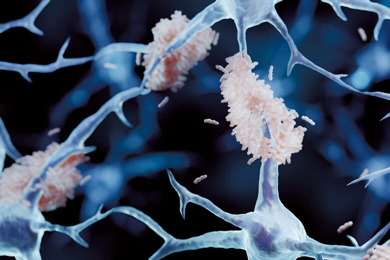 アルツハイマー病の原因となるアミロイドベータの沈着（イメージ）　ARTUR PLAWGO/ISTOCK