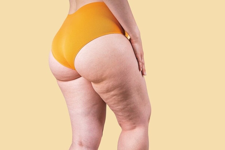 高価な化粧品やサプリでは凸凹は消えないが、減量や筋トレをすれば目立たなくなる　STARAS/SHUTTERSTOCK