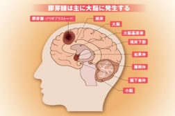 悪性脳腫瘍の中で最多、致死率も最高の膠芽腫…これらを標的にする物質を「防御壁」の先に届ける新手法に期待