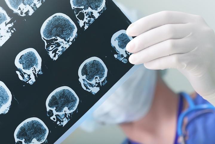 今後、神経系疾患が世界中で増えるおそれが懸念される......   sudok1-iStock