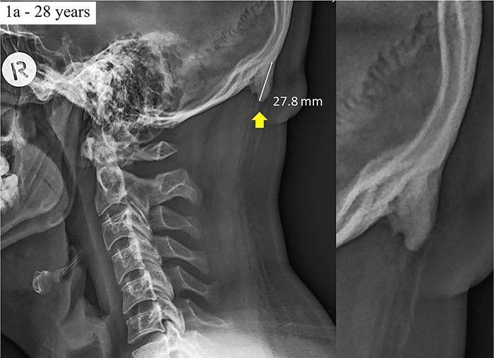 後頭部にツノ状の隆起が見られることが多くなっているという...... (Shahar & Sayer, Scientific Reports, 2018)