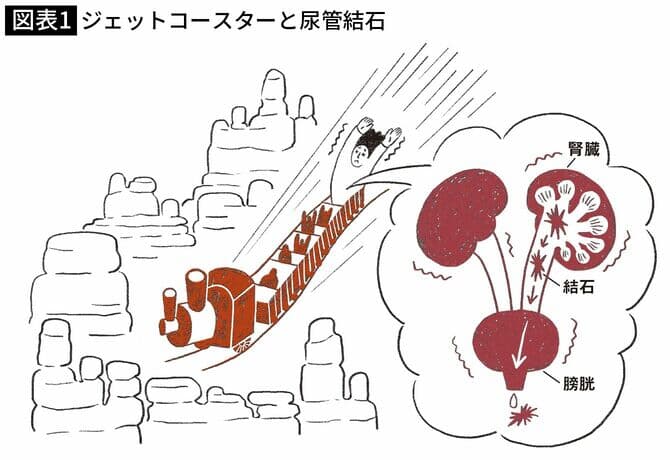 図表１　ジェットコースターと尿管結石