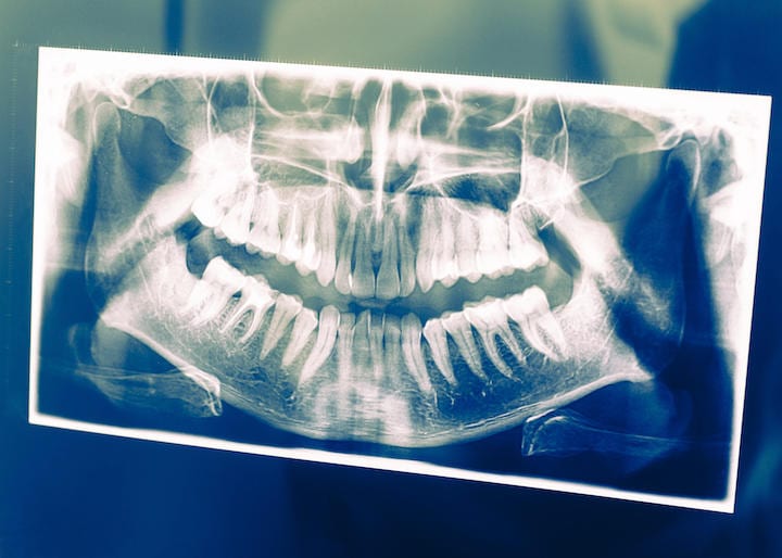 口腔内の細菌とアルツハイマー病とのつながりを示す研究結果が発表された　giorgiomtb1-iStock