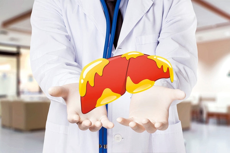 肝臓に脂肪がたまる脂肪肝は、不健康な食生活や運動不足により世界で増加している　HORILLAZ/ISTOCK