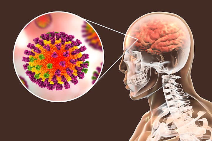 ウイルス性脳炎の既往症がある人はアルツハイマーを発症する確率が30倍高かった......Kateryna Kon-shutterstock