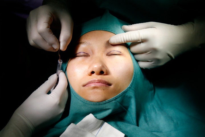 中国の病院で二重術に臨む女性患者　Nir Elias-REUTERS