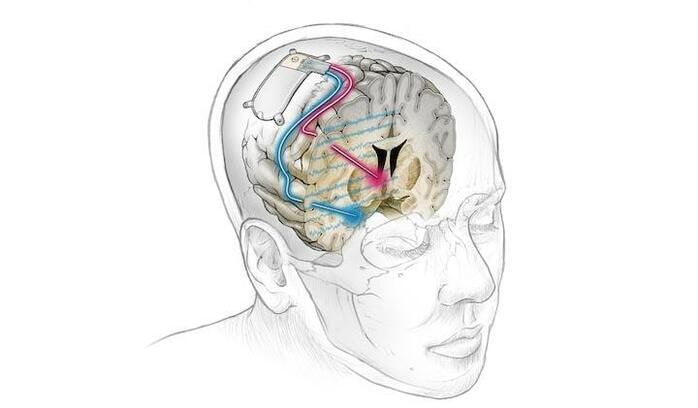 脳 うつ病に治療のための、新たな脳深部刺激療法が開発される | ニューズ