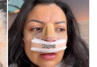 コンプレックスだった「鼻」の整形手術を受けた女性、結果に「つらい...」 手術前後の姿を公開