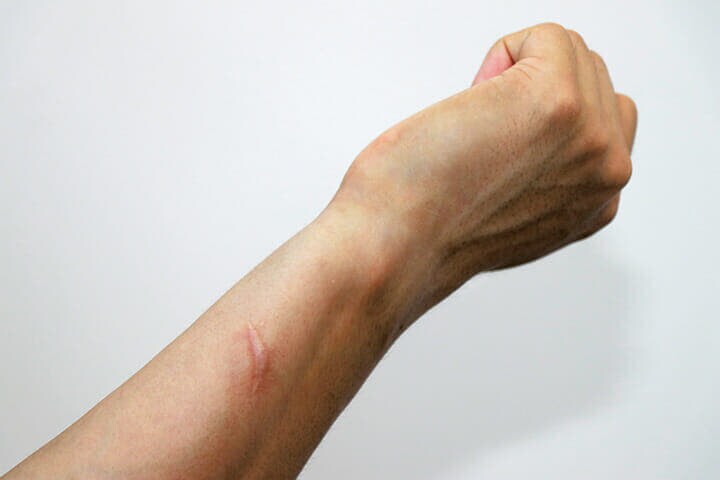 オーストラリアのワーホリで怪我を負った岡野隼大