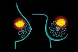 視覚的なパターンを数値化する「トポロジー」が乳癌治療を変える！　腫瘍の構造を数値化する新手法とは